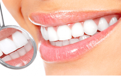 Clareamento dental: mitos e verdades sobre o tratamento
